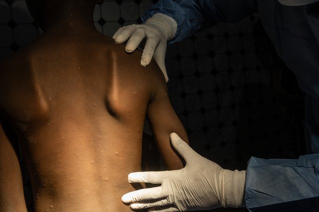 Een tienjarige jongen heeft symptomen van mpox in DRC